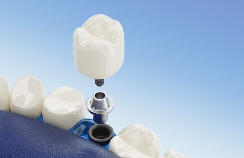 What To Expect During Dental Implant Placement?