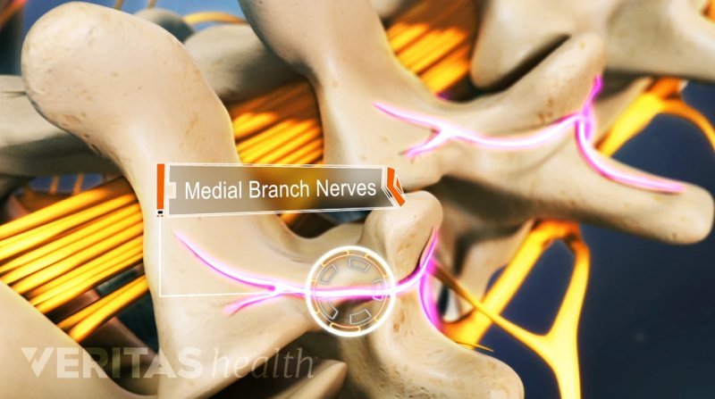 medial branch nerve block